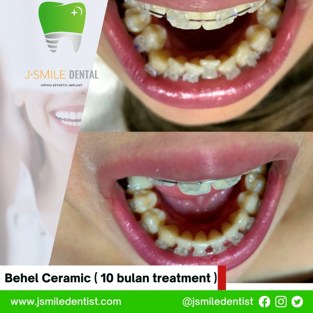 Behel Ceramic (10 bulan treatment)
