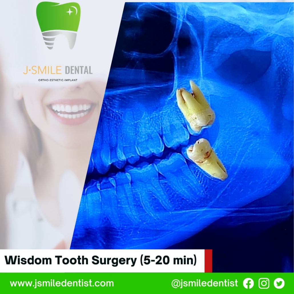 Wisdom Tooth Surgery (5-20 min)
